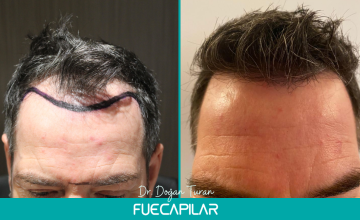 Dr. Turan - FUECAPILAR Clinic, NW IVa + Diffuse thinning, 4100 grafts