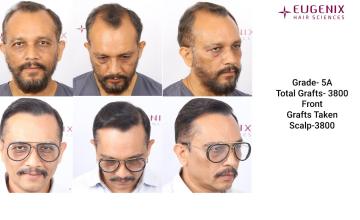 TRANSFORMATION IS INDEED A DECISION | DR. ARIKA BANSAL | EUGENIX HAIR SCIENCES