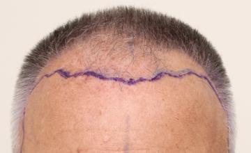 Dr. DORIN - FUE 1712 grafts Front/Temple