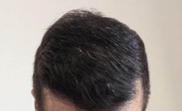3400 grafts on a Diffuse Thinning case – 1 year after - HDC Hair Clinic
