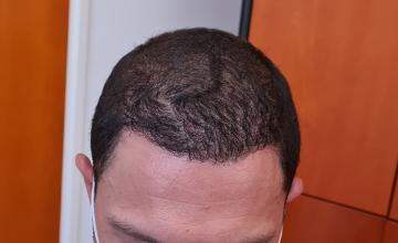 Increase of density in already transplanted area with 1872 Grafts – HDC Hair Clinic