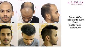 EUGENIX HAIR SCIENCES | RESULT AT 10 MONTHS | DR. ARIKA BANSAL