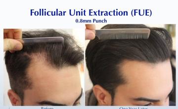 Filling in a Weakening Hairline (2635 FUE grafts): Carlos K. Wesley, M.D. (NYC & LA)