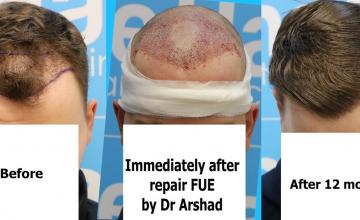 1411 grafts by Dr Arshad - FUE result (The Hair Dr, Leeds, UK)