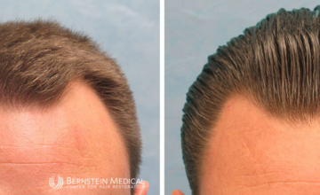 Norwood Class 3 - 1,354 Grafts FUE-R - Dr. Robert Bernstein