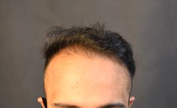 Dr. Arocha | 1500 Graft FUE | 1 year results