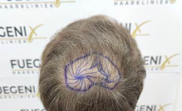 Dr. Munib Ahmad - 2820g - Cowlick Hairline + 2 Whirled Crown + 2 Big Scars + 1 Drainhole in One-Surgery - FueGenix - The Netherlands