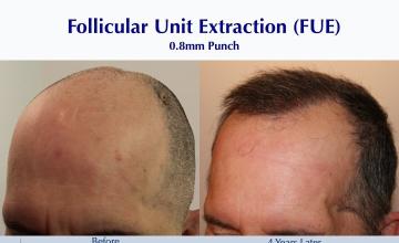 Frontal Scalp Scar Coverage (2530 FUE grafts): Carlos K. Wesley, M.D. (NYC & LA)