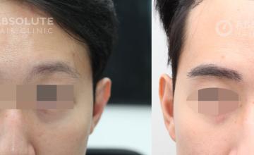 Eyebrows transplant in Asians, 502 grafts by Dr.Kongkiat Laorwong, Bangkok, Thailand