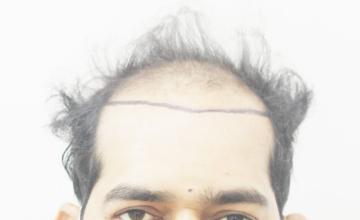 Dr. Suneet Soni - 5500 Grafts, Combine Technique FUT + FUE + Beard Grafts, Natural Hairline