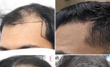 Eugenix July 18/19 with Dr. Pradeep Sethi and Dr. Arika Bansal 3811 Grafts