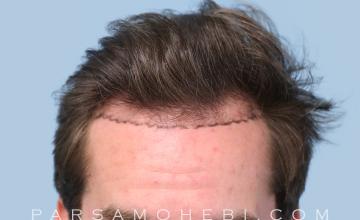 29-Year Old Male with Class III Hair Loss by Dr. Parsa Mohebi