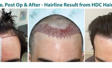 Hairline Restoration with 2350 FUE Grafts from HDC Hair Clinic