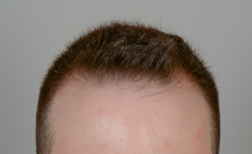 Robert Haber, MD - 1533  grafts FUE, Hairline - 12 months