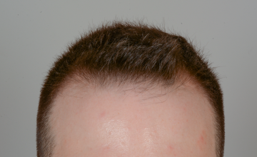 Robert Haber, MD - 1533 grafts FUE, Hairline - 12 months