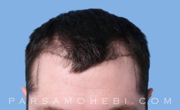 25 Year Old Male with Class III Hair Loss by Dr. Parsa Mohebi