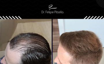 Dr. Pittella • Norwood 4/5, -5280- Fine Smooth Blond Hair: (VIDEO)