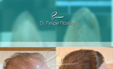 Dr. Pittella • Norwood 5, Large head, Thin Hair: SOLVED (WET)