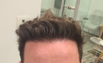 Lowering of Hairline – 2680 FUE Grafts – HDC Hair Clinic – Dr Maras