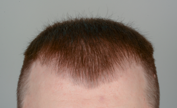 Robert Haber, MD - 2239 grafts FUE, Front & Crown - 6 months