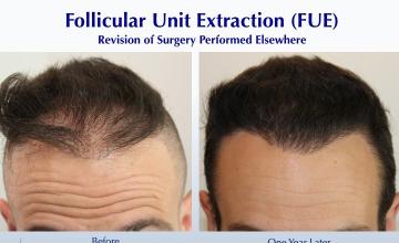 Repairing a “Wronged” Patient with Scalp & Beard FUE (2760 FUE grafts): Carlos K. Wesley, M.D. (NYC & LA)