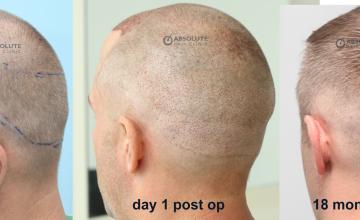 Dr. Kongkiat Laorwong, MD, FISHRS,  FUE 1608 grafts hairline