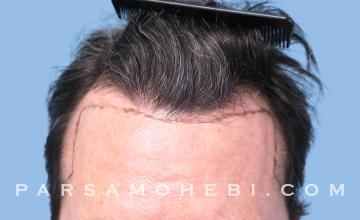 39 Year Old Male with Class III Hair Loss by Dr. Parsa Mohebi