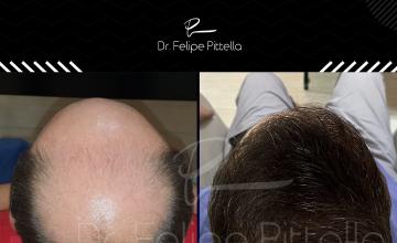 Dr. Pittella • Norwood 7, Large head, Average donor: WET and dry comb through: SOLVED