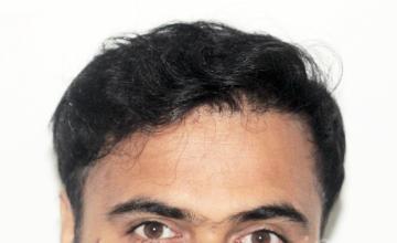 Dr. Suneet Soni - 5300 Grafts, Combine FUT + FUE + BHT Technique , NW:VI