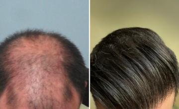 10 Years Since My First Hair Transplant