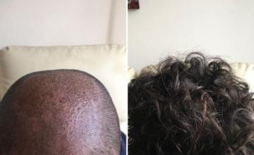 Dr. Munib Ahmad Front and Crown Hair Transplant 12 Months Later