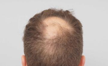 Dr B Farjo 2800 FUE (over two procedures in 2018 and 2023.)