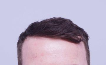 Dr B Farjo 1524 FUE g for hairline boost
