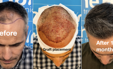 DR Arshad / The Hair Dr Clinic (Leeds,UK) - 2148 grafts by FUE / 0 -11 Months (grown out close up result)