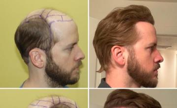 Dr Zarev 11,941 grafts. 1st procedure 8,321, 2nd procedure 3,620