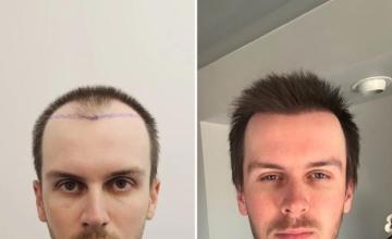 ONLY 4 MONTHS! Dr Ruk, 3763 grafts (9428 hairs), 28 years old norwood 3-4