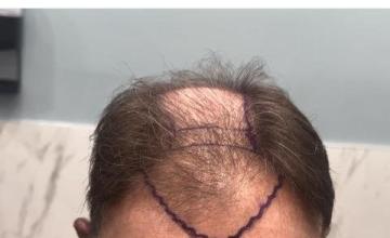 5700 Grafts!! Dr. Sean Benham