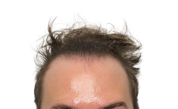 Dr Matt Egan - 2,103 Grafts | FUE | Hairline | 12 Months