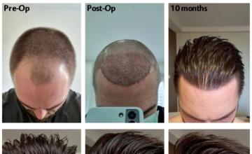 Dr. Laorwong / Absolute Hair Clinic, Bangkok - 2882 Grafts (FUE) - 10 month results