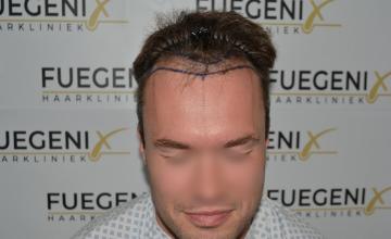 Dr. Munib Ahmad - 2189g - From Hat ​🎩​ Damon to Matt Damon - Brown Hair Hairline - FueGenix - The Netherlands