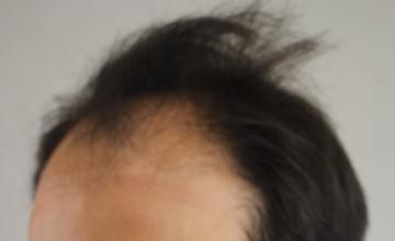 Dr. Rahal - 5020 Grafts over two sessions - FUE