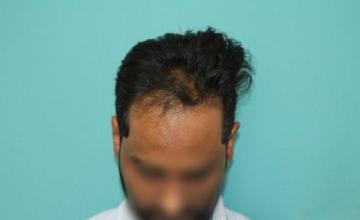 Dr Raghu Reddy, 2200 grafts manual FUE, 6 months result