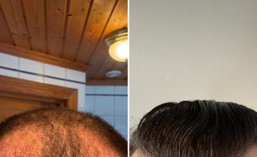 My hair transplant journey done by Dr Emil George in Norway mid January 2025, 2500 grafts in front and crown