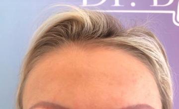 Ozlem Bicer MD-Eyebrow Transplantation 860 Grafts FUE