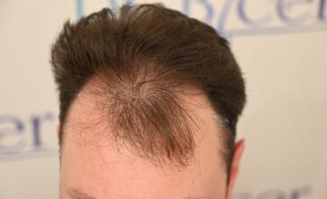 Ozlem Bicer MD-Hair Transplant-2910 Grafts FUE by micro-motor, 7. months result