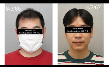 Dr.Ratchathorn Panchaprateep (Absolute hair clinic) Norwood 5 patient: 1 year 11 months after 4226 grafts FUE