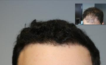 PANINE, MD | Chicago Hair Transplant Clinic | 2,594 Graft FUE Hair Transplant Results at One Week and One Year
