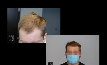 PANINE, MD | Chicago Hair Transplant Clinic - FUE Hair Transplant with 2,033 Grafts