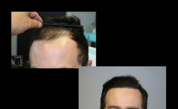 PANINE, MD | CHICAGO HAIR TRANSPLANT CLINIC - 2,421 Graft FUE Hair Transplant Results After 9 Months