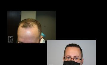 PANINE, MD | Chicago Hair Transplant Clinic - 2,800 Graft FUE
